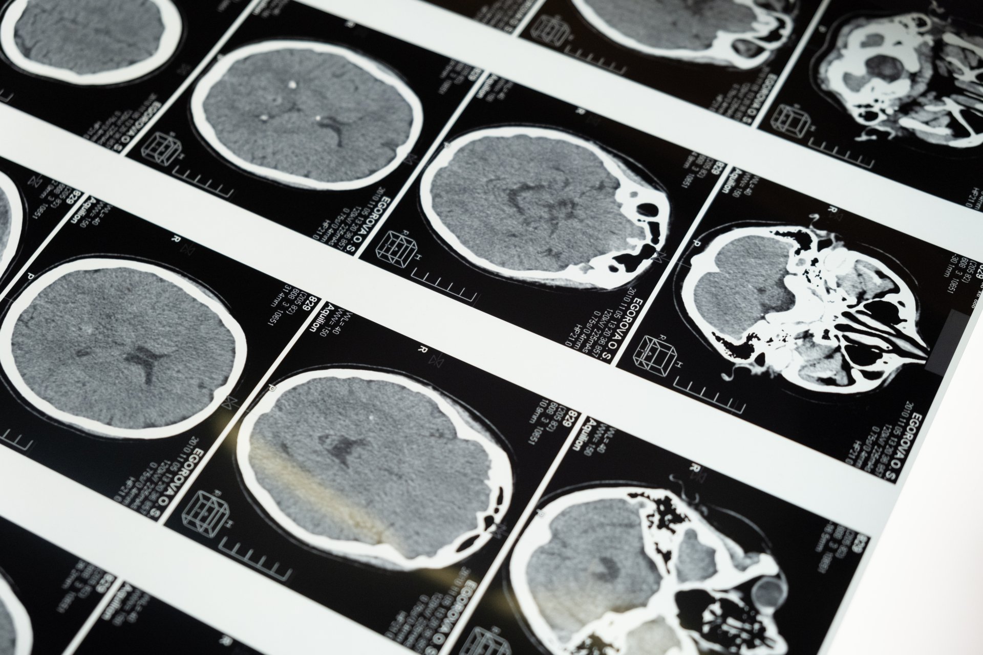 Understanding Traumatic Brain Injuries: Recognize, React, and Recover