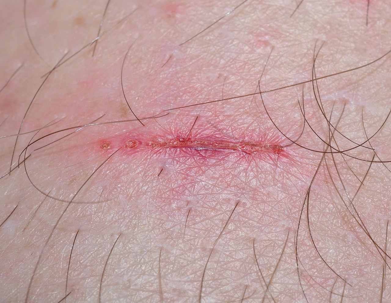 What to Do After an Injury in New Mexico