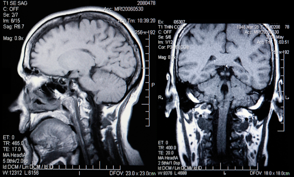 understanding-the-fiscal-impact-of-a-traumatic-brain-injury