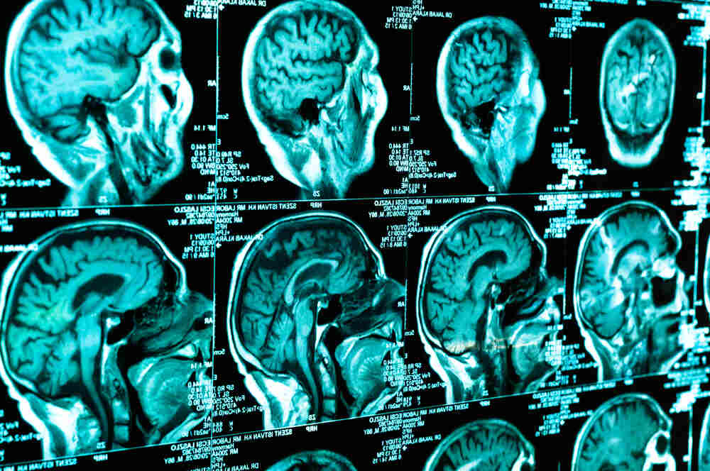 everything-you-need-to-know-about-traumatic-brain-injuries