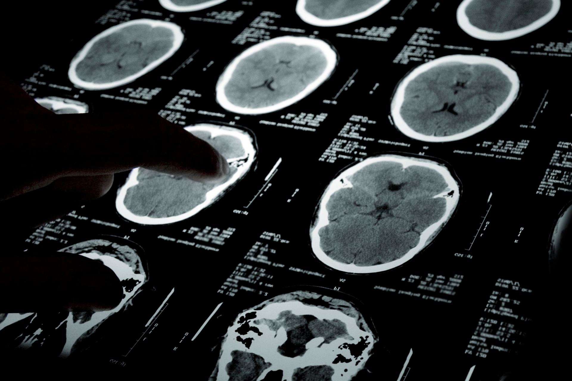 $100,000 Settlement in Chicago TBI Case