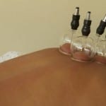 The Benefits of Cupping Therapy