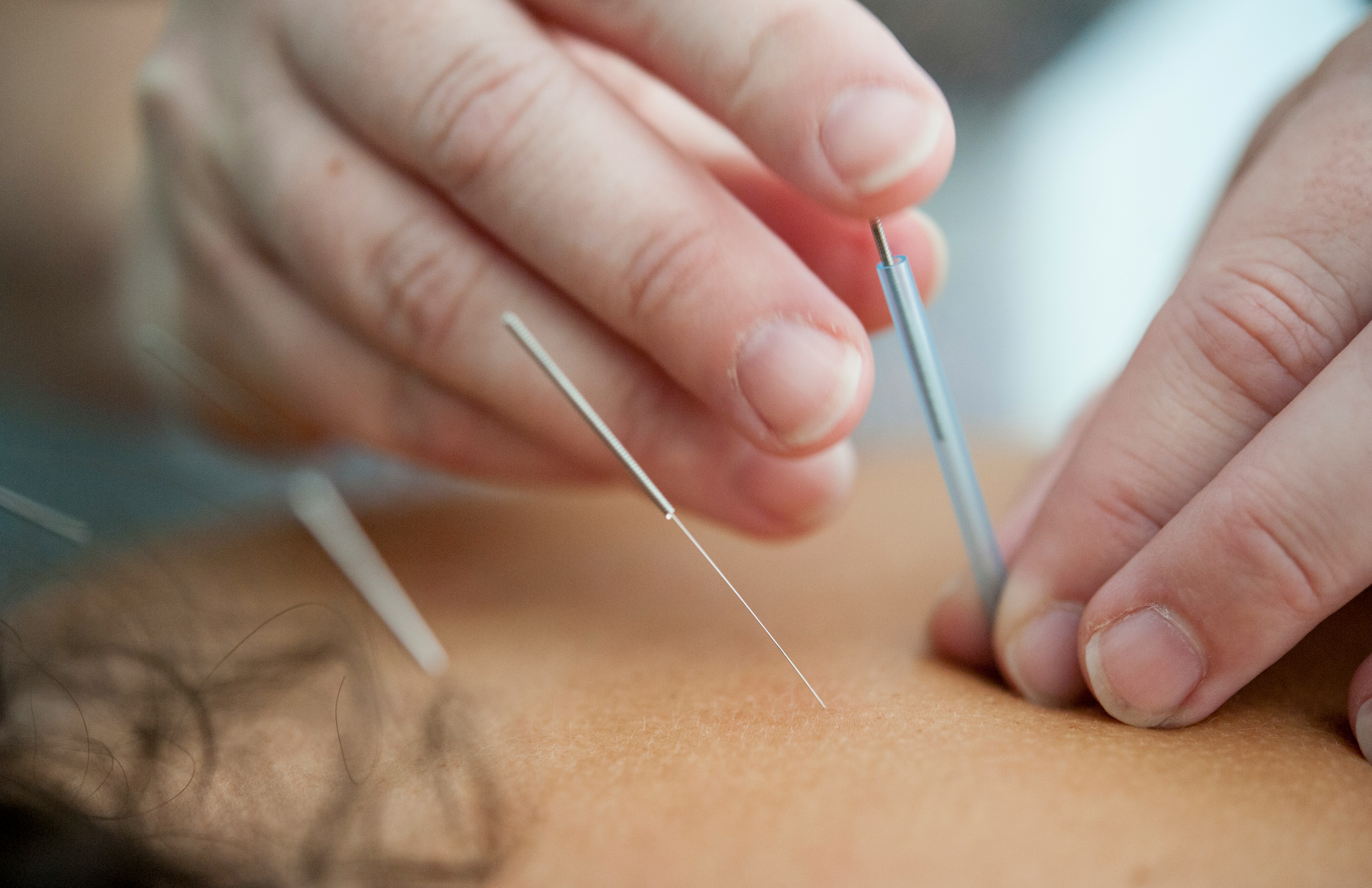 How Acupuncture Supports You Through the Seasonal Shift Into Fall