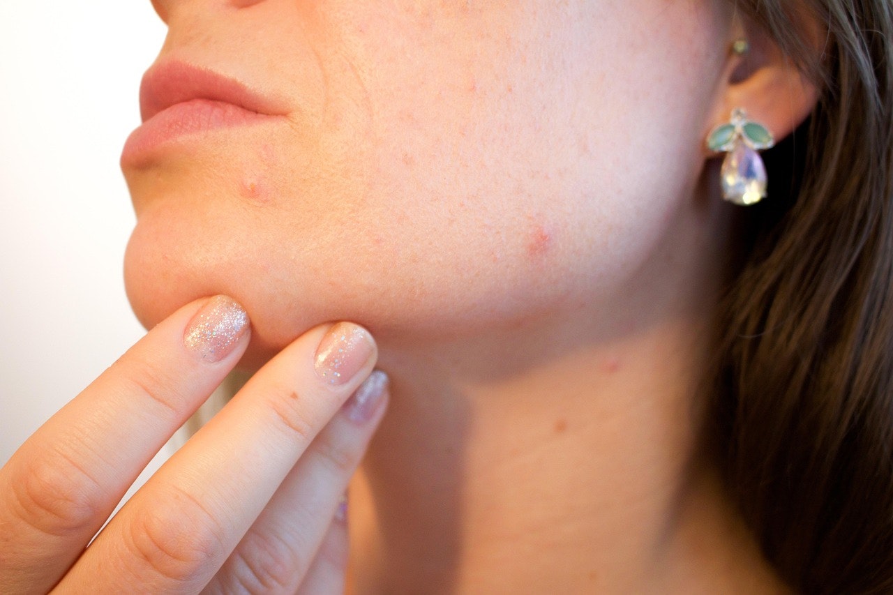 Acne Scars to Sun Damage: How Microneedling Addresses Your Specific Skin Concerns