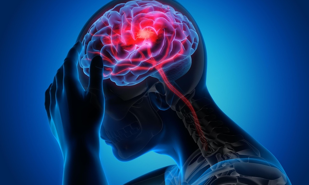 Acupuncture as a Supportive Option for Episodic Migraine Relief
